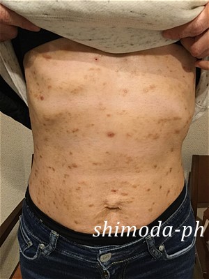 痒疹アトピーお腹Nさん