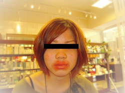 口囲皮膚炎の写真